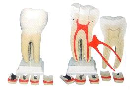 Dente molar ampliado em 8 partes com evolução da cárie